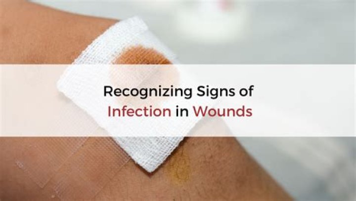 Can burn wounds get infected?