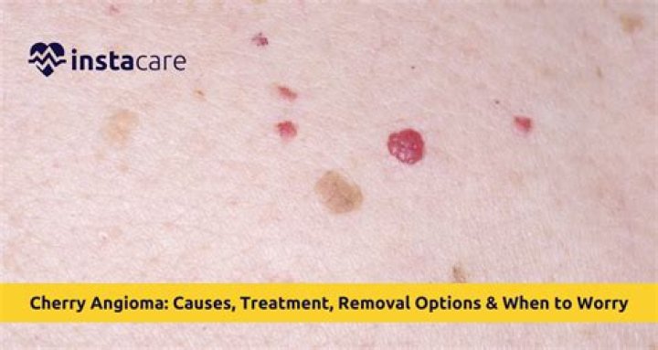 Can I remove my own cherry angioma?