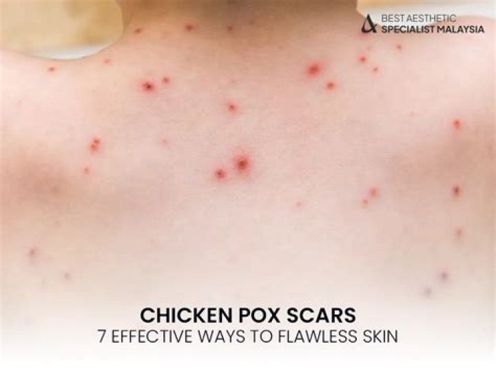 Can microneedling get rid of chicken pox scars?
