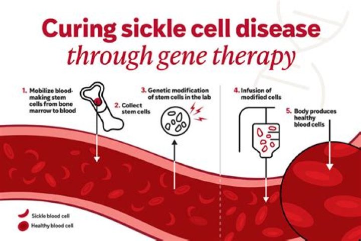 How is sickle cell anemia treated in pregnancy?