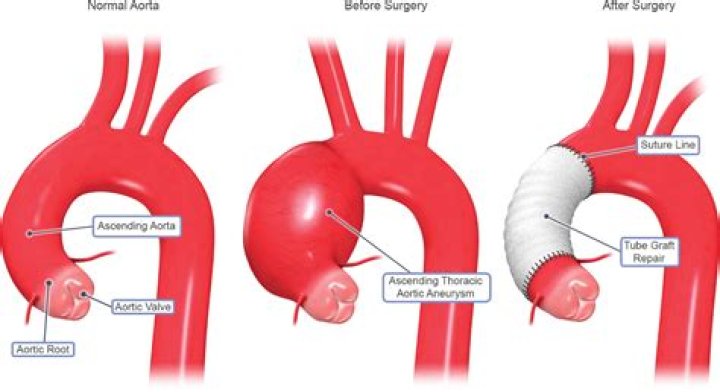 How long can you live with an aneurysm in your aorta?
