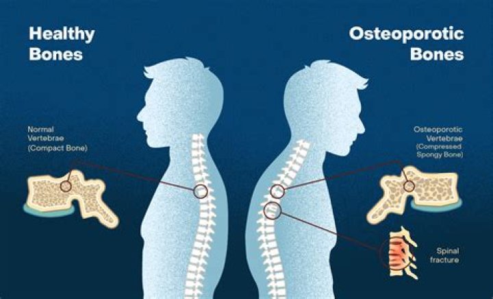 How many people in India have osteoporosis?