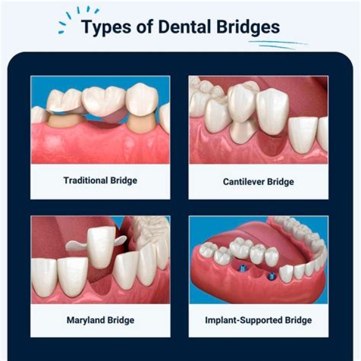 How much is a top bridge for teeth?