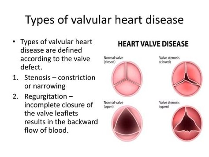 What are examples of valvular disease?