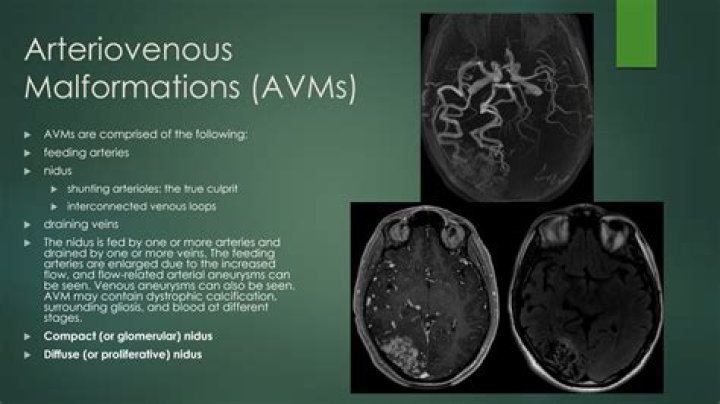 What causes brain cavernoma?