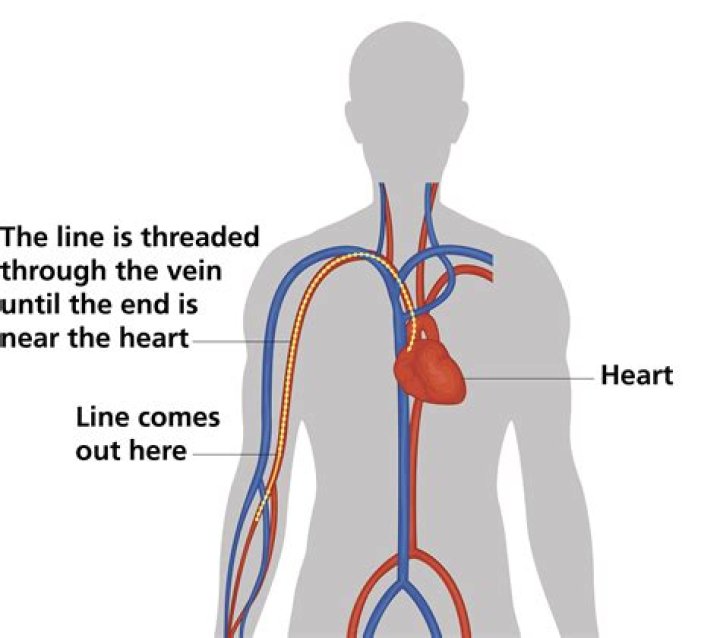 What is a PICC line for intravenous?