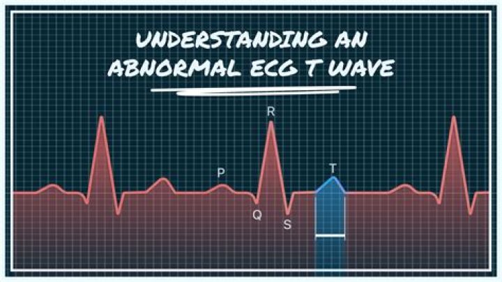 What is abnormal T-wave in ECG?