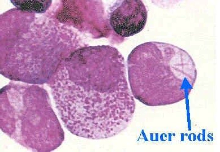Which leukemia has Auer rods?