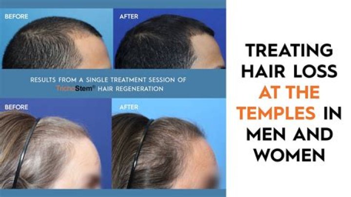 Why is my hair breakage off at temples?